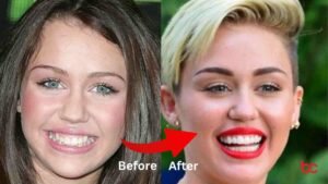 Miley Cyrus's Teeth